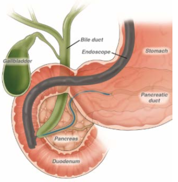 ERCP, ενδοσκοπική αφαίρεση λίθου
